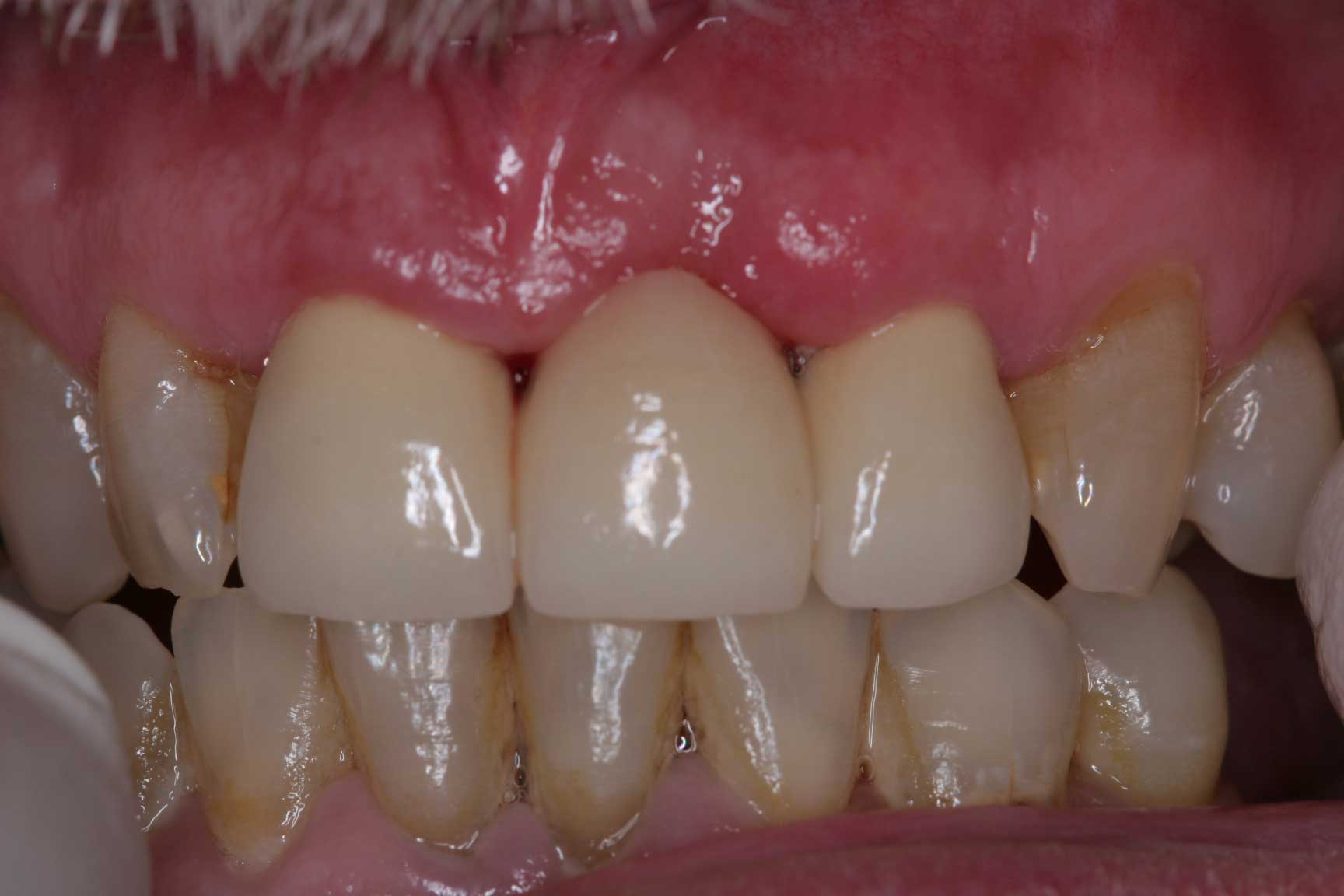 Bridge postop dental accident bridge postop