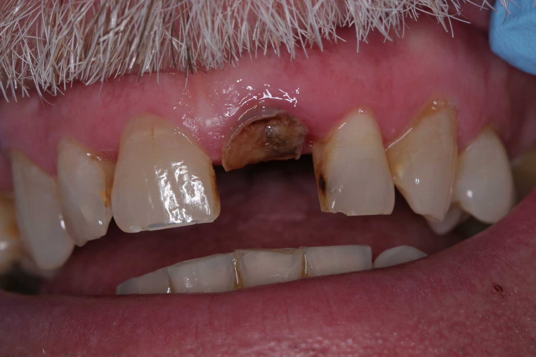 Bridge preop dental accident bridge preop