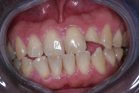 Crown preop dental accident crown preop