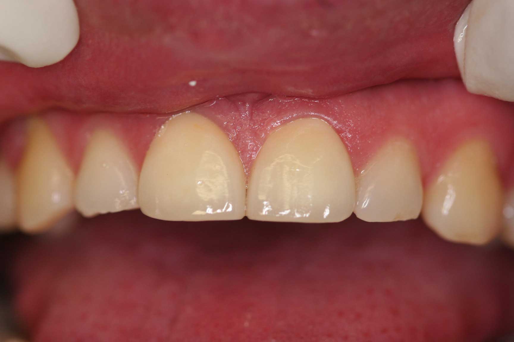 Crown postop dental accident crown postop