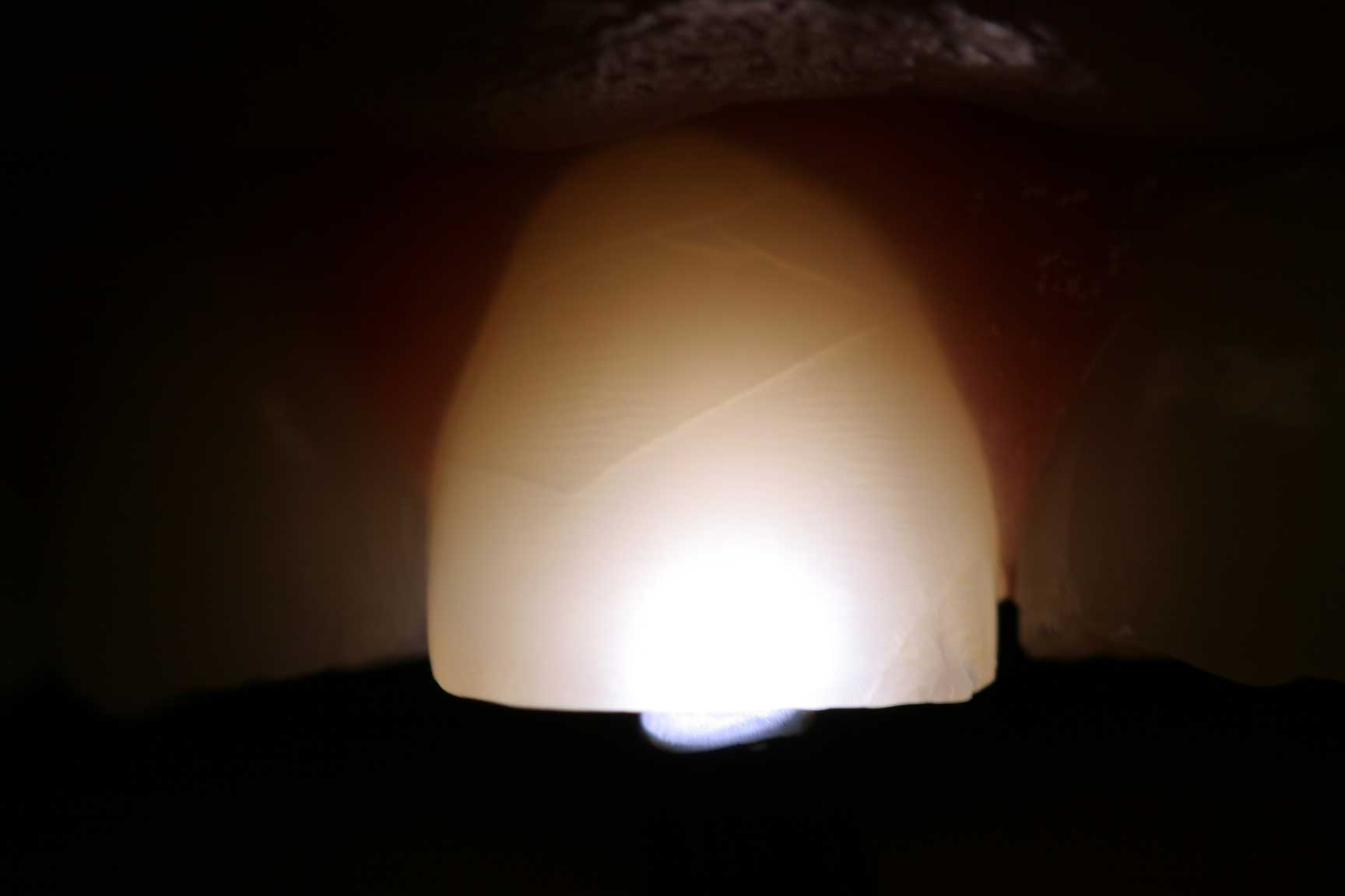 Crown preop dental accident crown preop
