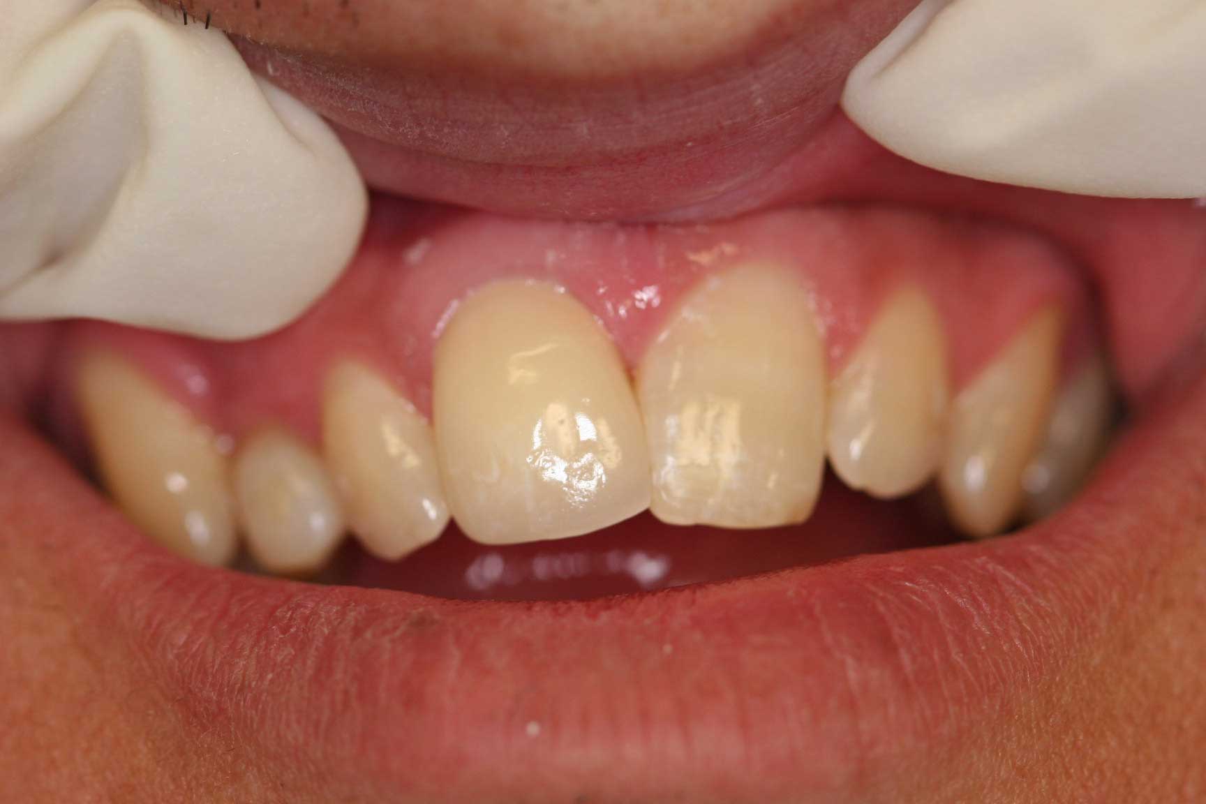 Crown postop dental accident crown postop