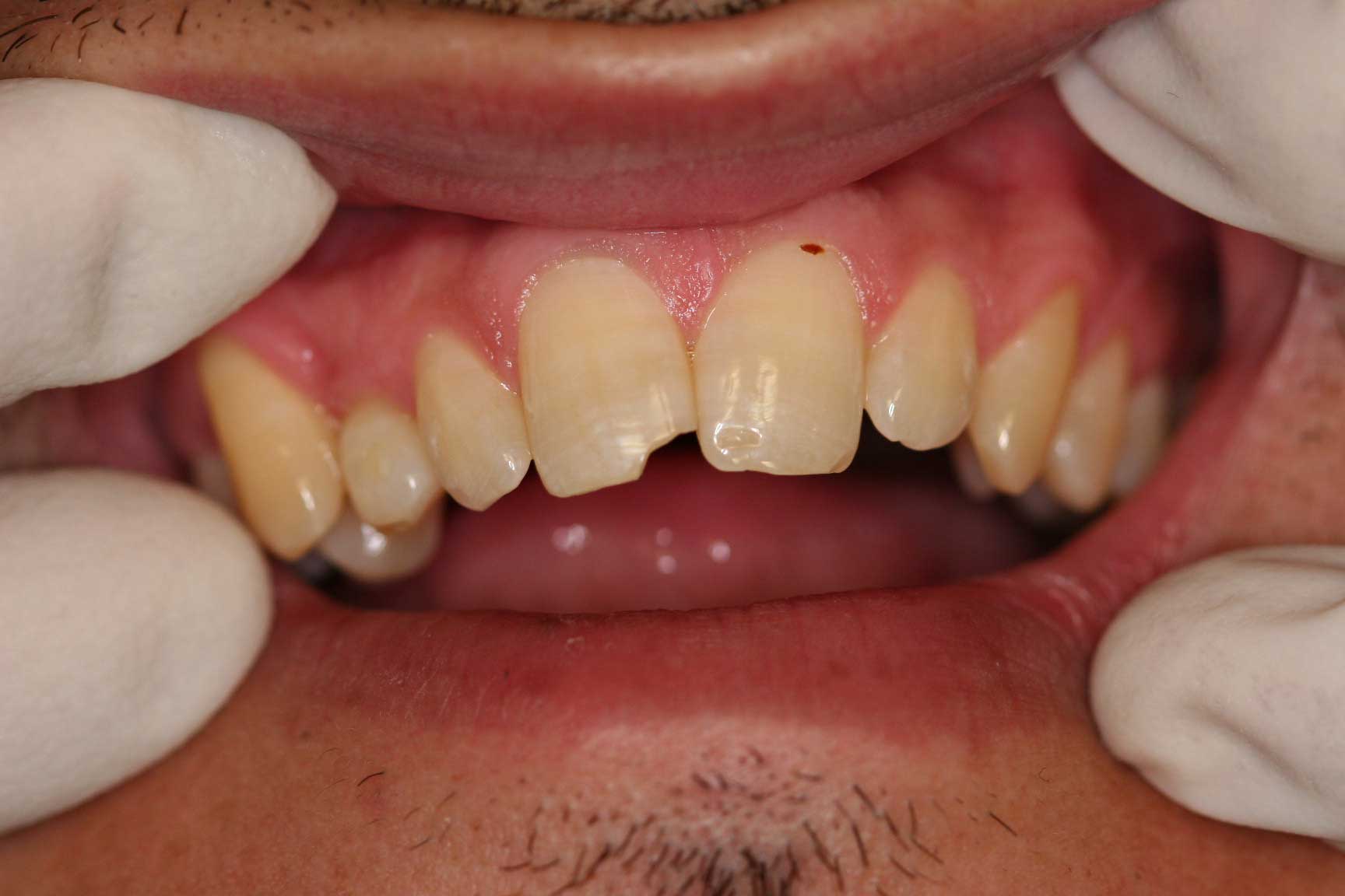 Crown preop dental accident crown preop
