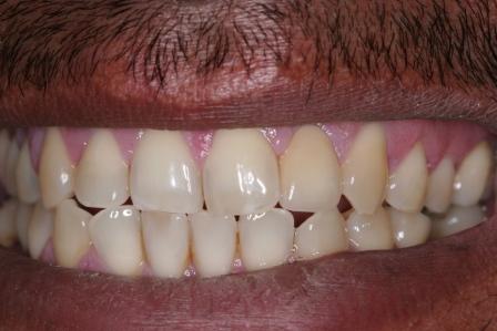 Crown postop dental accident crown postop